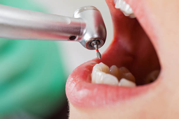 Best Emergency Wisdom Teeth Removal in Garfield Heights, OH
